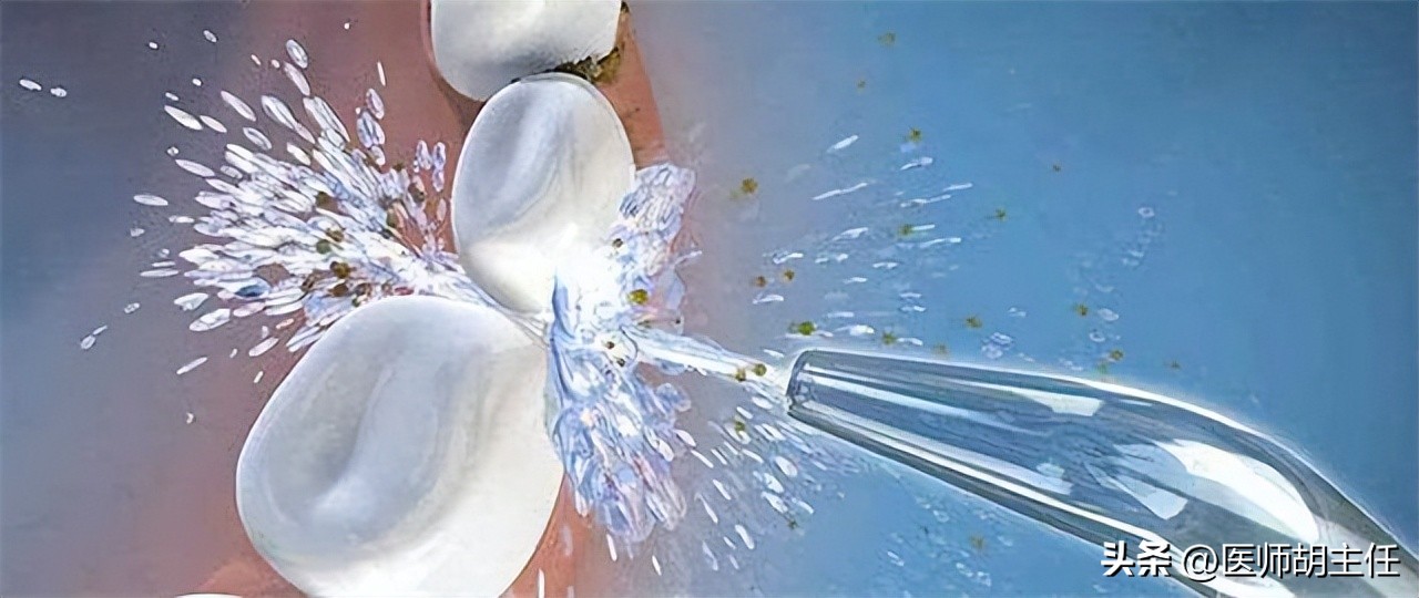 牙缝中的牙结石怎么去除,牙缝的牙结石怎么自己去除