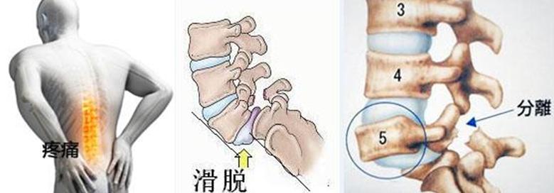 腰椎滑脱手术内固定失败症状,腰椎滑脱前移和后移症状一样吗