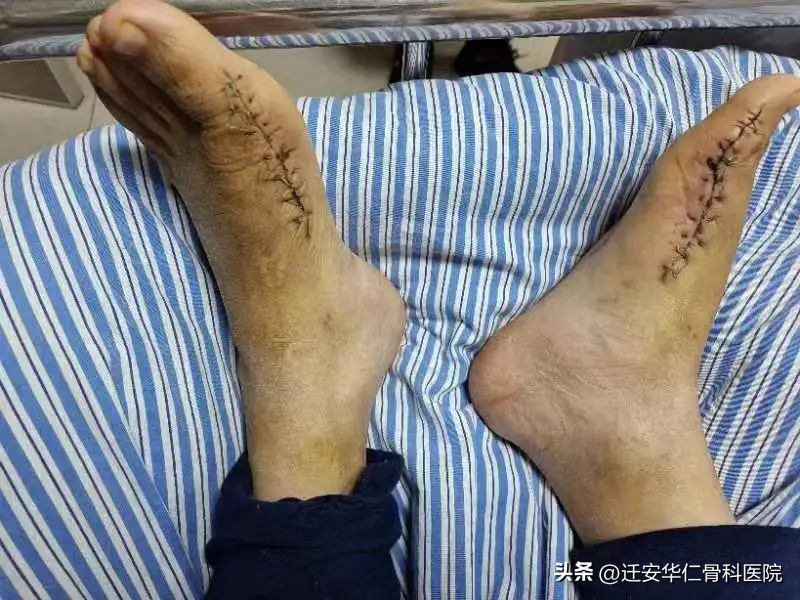 痛风结石为什么有的人不早点治疗,痛风病人的痛风结石怎么去除