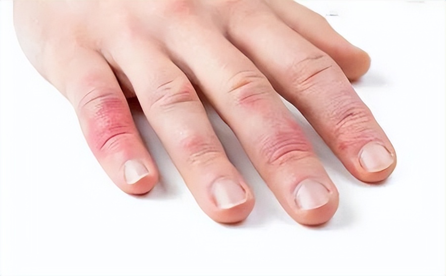 拿什么拯救你我的冻疮,5个妙方让你冬天不再有冻疮