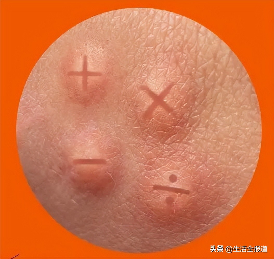 蚊子包止痒妙招,怎么给蚊子包止痒