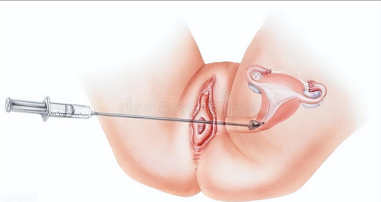 派特灵派特生物科普｜妇科须知：子宫内膜息肉的检查方法