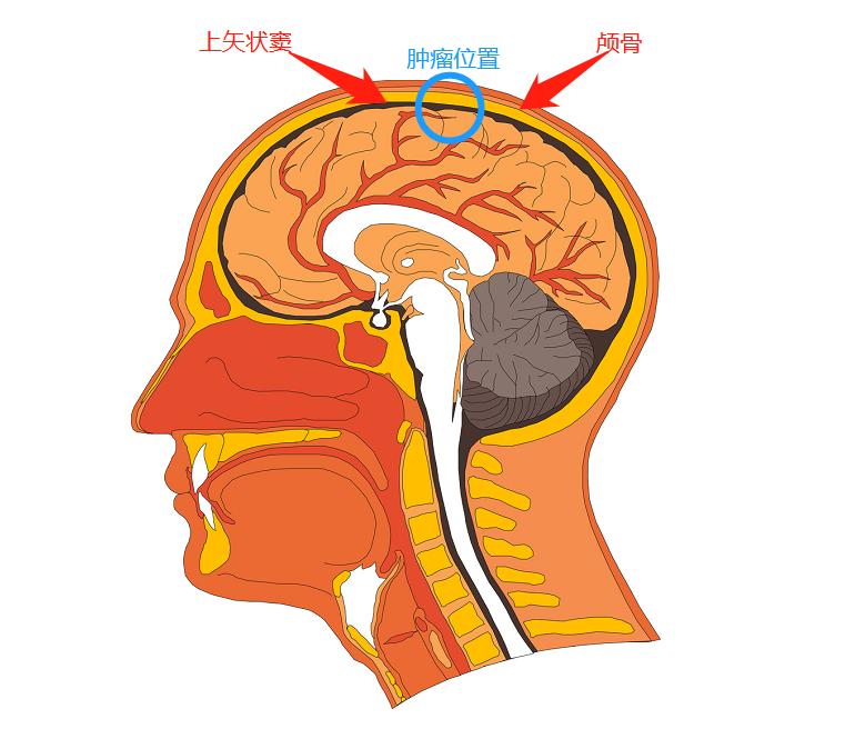 3岁男孩确诊脑肿瘤,小伙脑肿瘤手术