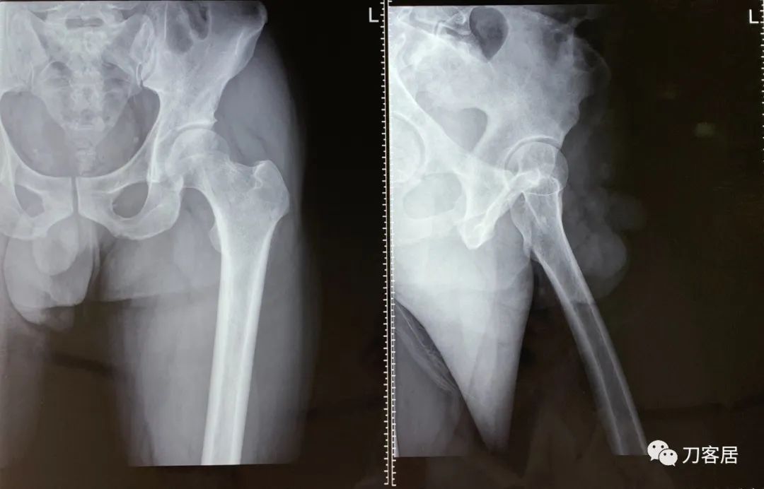 20岁腰5骶1椎间盘突出怎么办,腰5骶1椎间盘突出急性发作