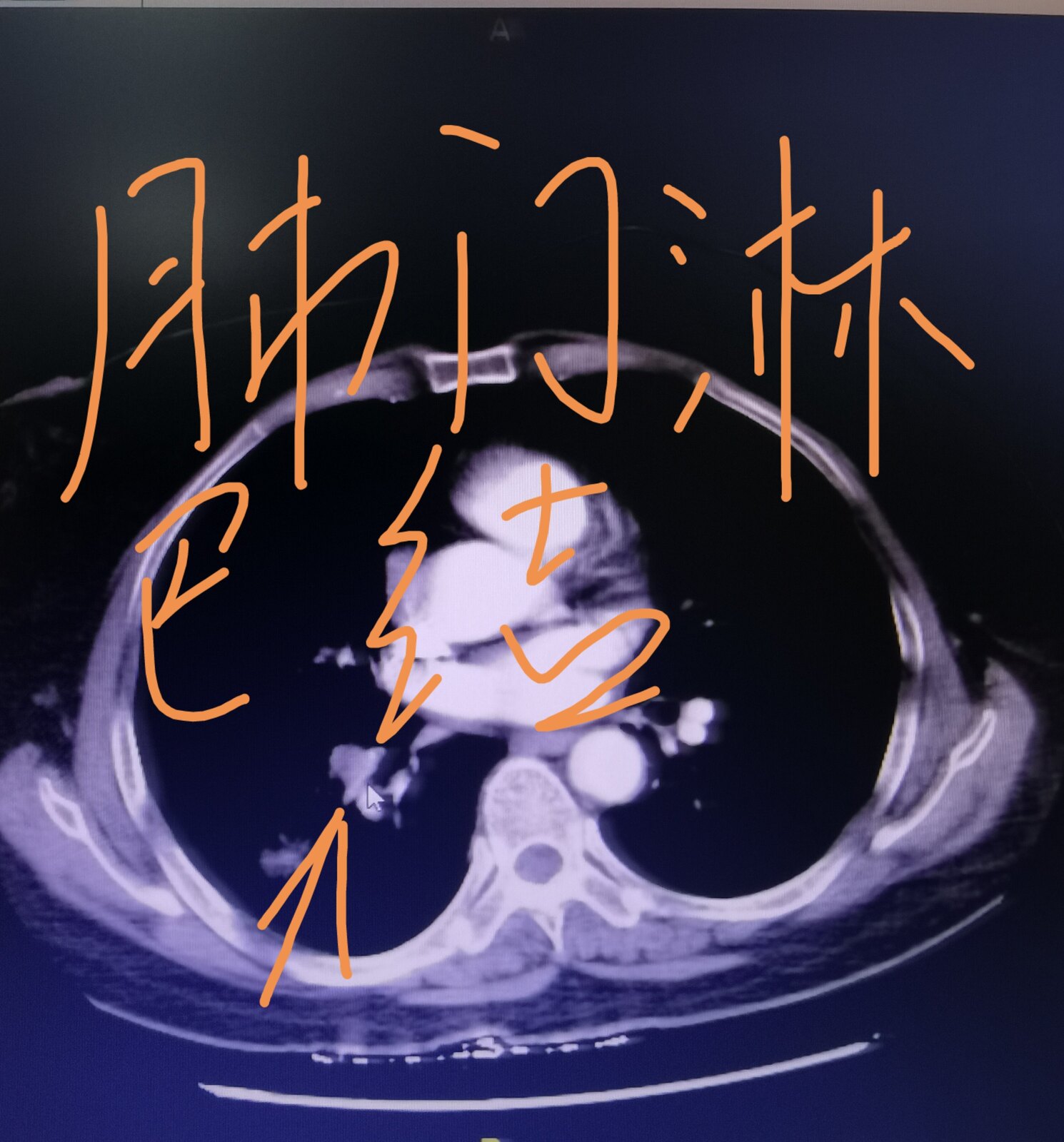 刘懿博士说肺癌脑转移,刘懿博士说肺癌患者