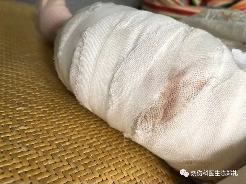 慢性创面患者的敷料运用及选择,创面换药敷料的选择