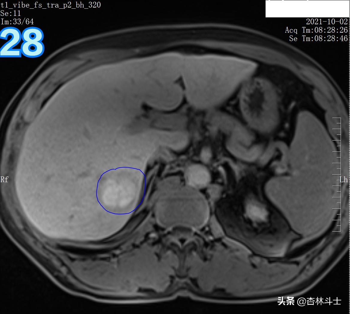 肝癌8公分肿瘤能活多久,肝癌细胞最大长多大