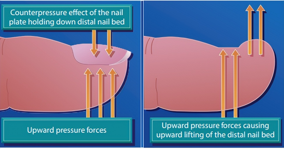甲沟炎十年,有史以来最严重的甲沟炎