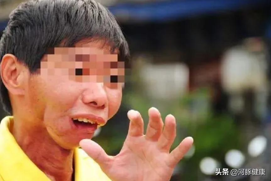 傅松槟榔,36岁歌手傅松因口腔癌去世