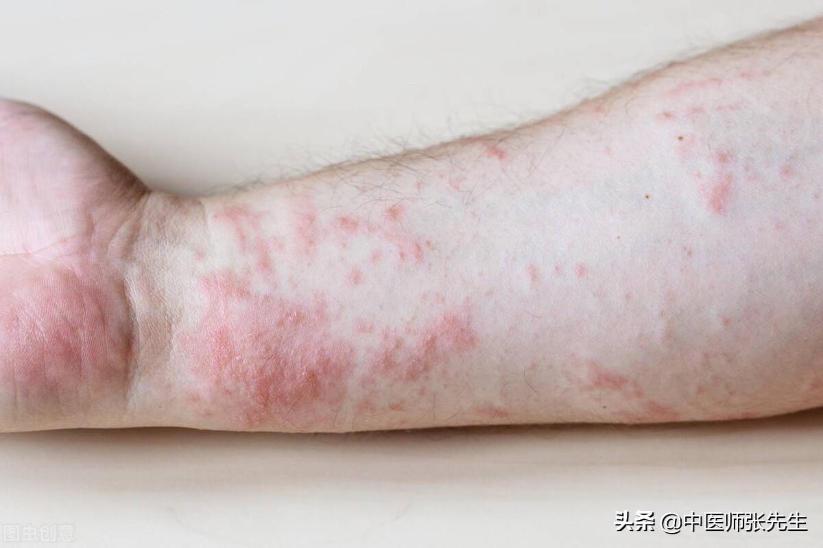 全身丘疹的病因分析及中医治疗方法