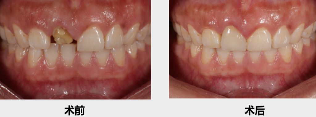 牙齿残冠残根必须拔牙吗,牙齿残根还能根管治疗吗