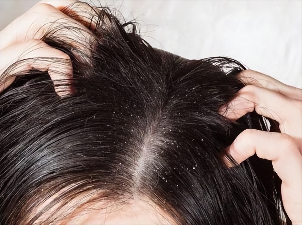 游泳导致脱发怎么办,头发稀疏游泳怎么扎