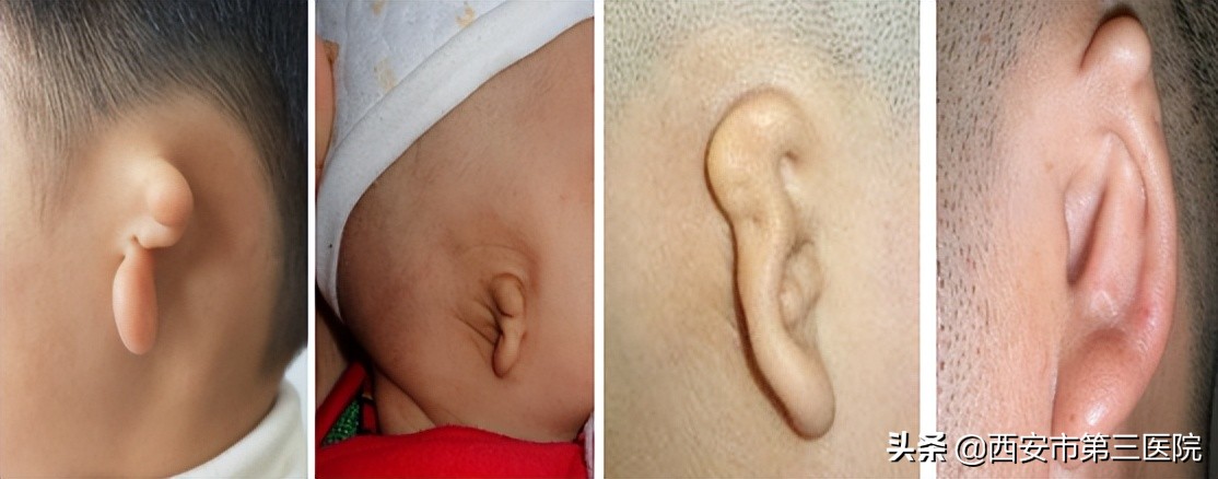 宝宝耳朵不对称怎么治,宝宝耳朵畸形左耳封闭能治好吗