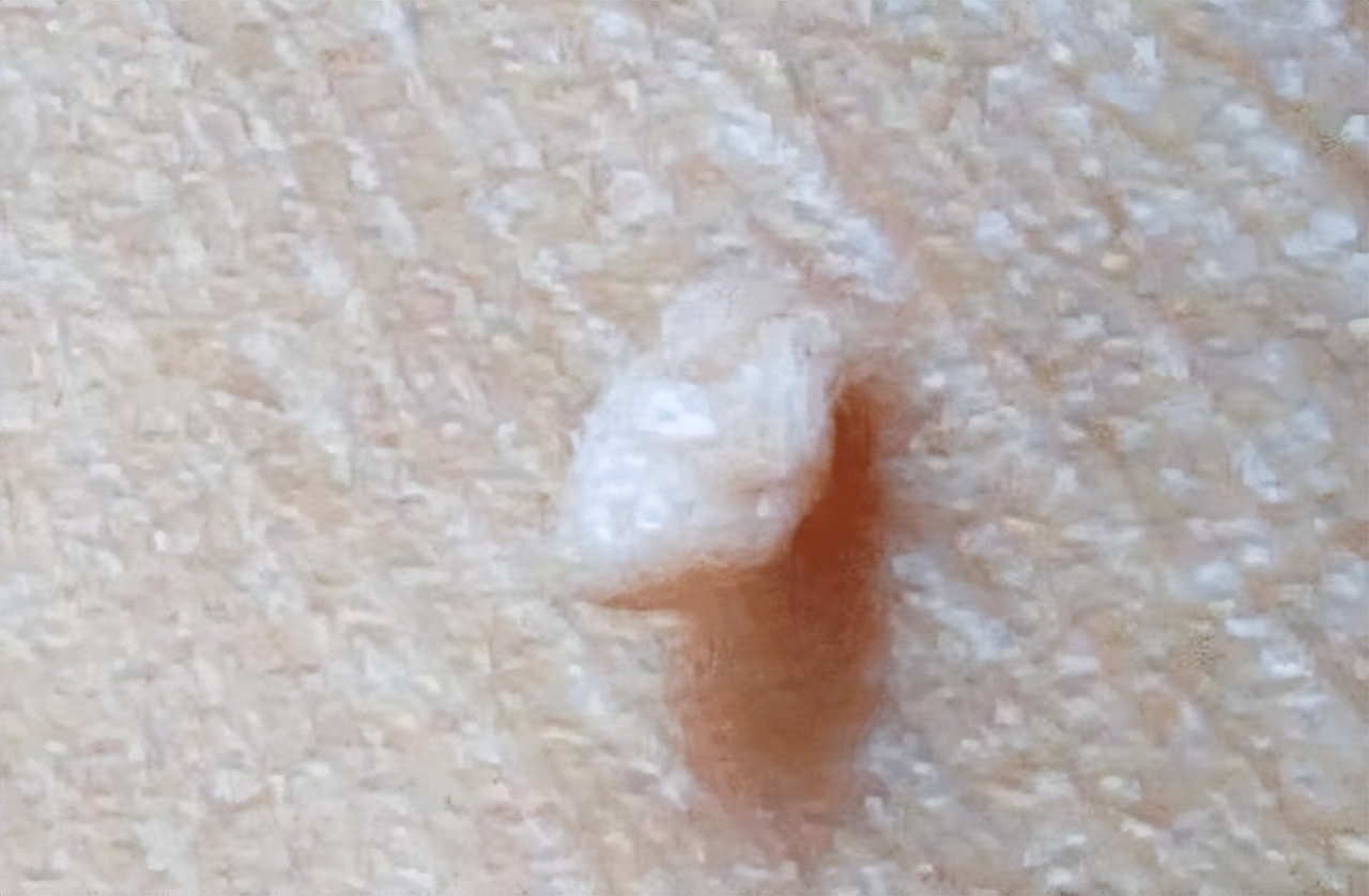 脖子和腋下的小肉粒可以揪了吗,脖子上的小肉粒揪掉后会怎样