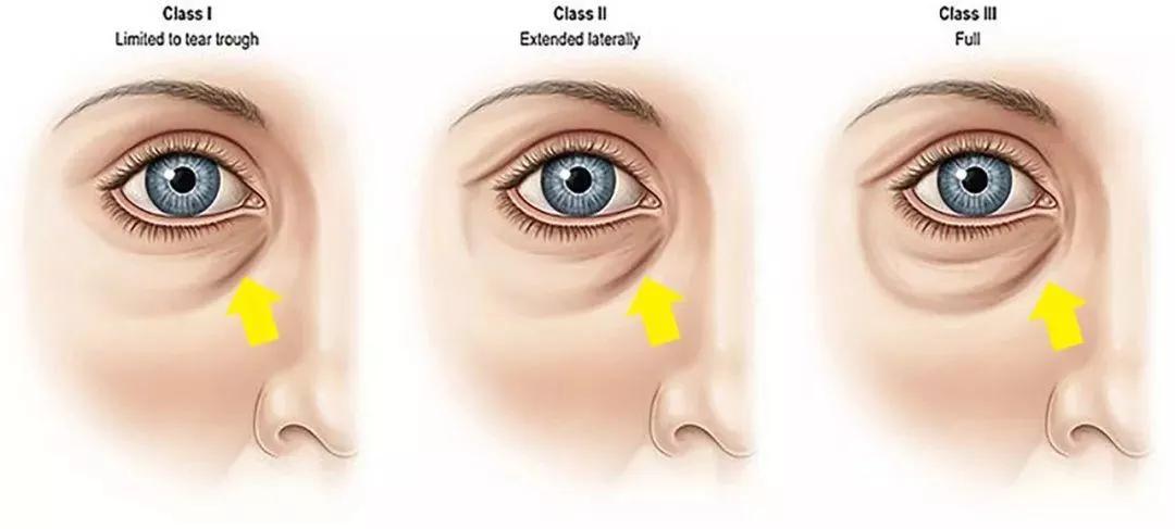 最快的方法帮你淡化泪沟,只需知道一招轻松消除显老泪沟