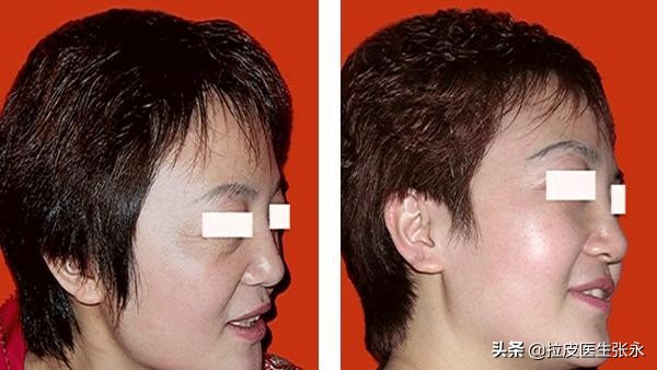 内窥镜拉皮除皱,拉皮和内窥镜拉皮哪一个好