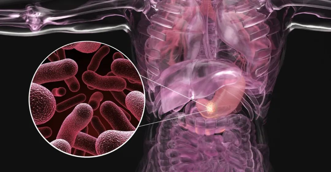 2年前被查出胃印戒细胞癌,现在还好吗?