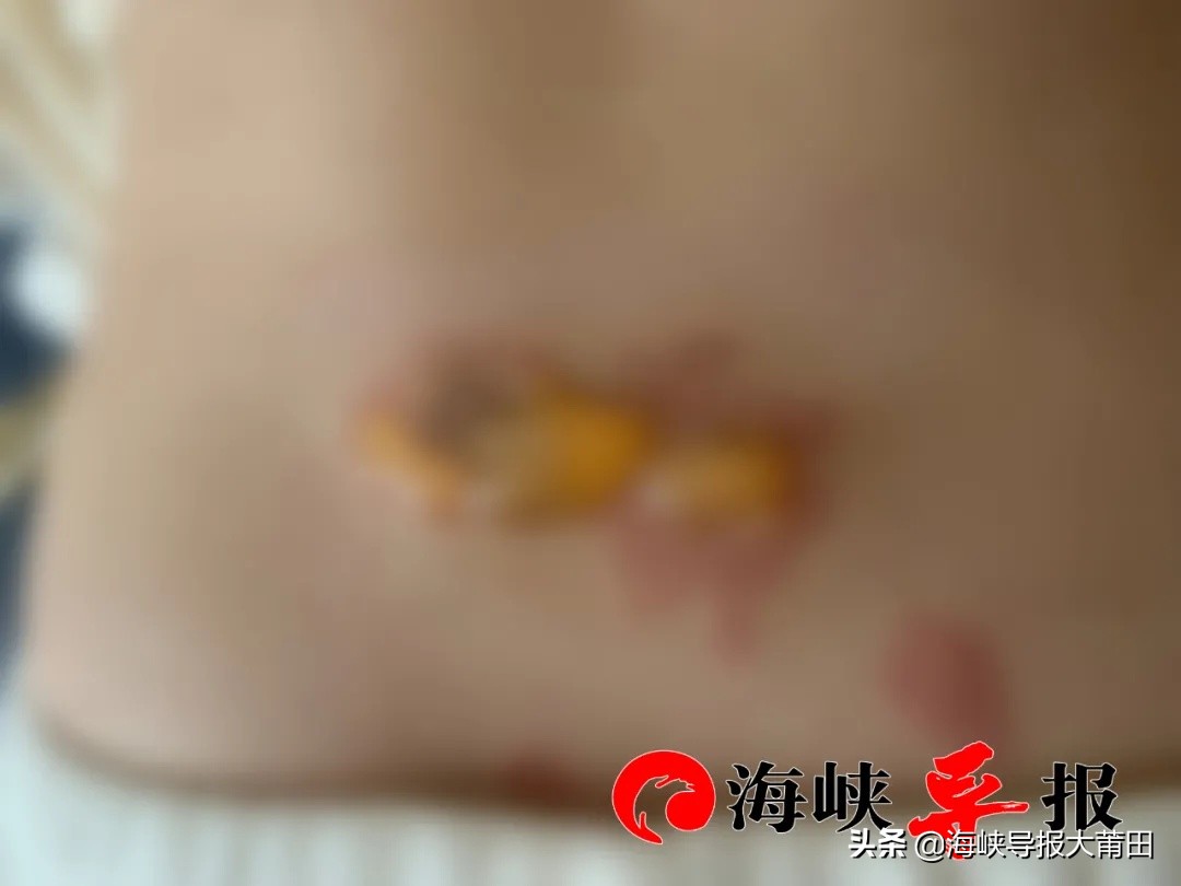 女子调理宫寒致皮肤烫伤?莆田美欧产后康复中心:愿负100%责任,赔偿诉求要有理有据