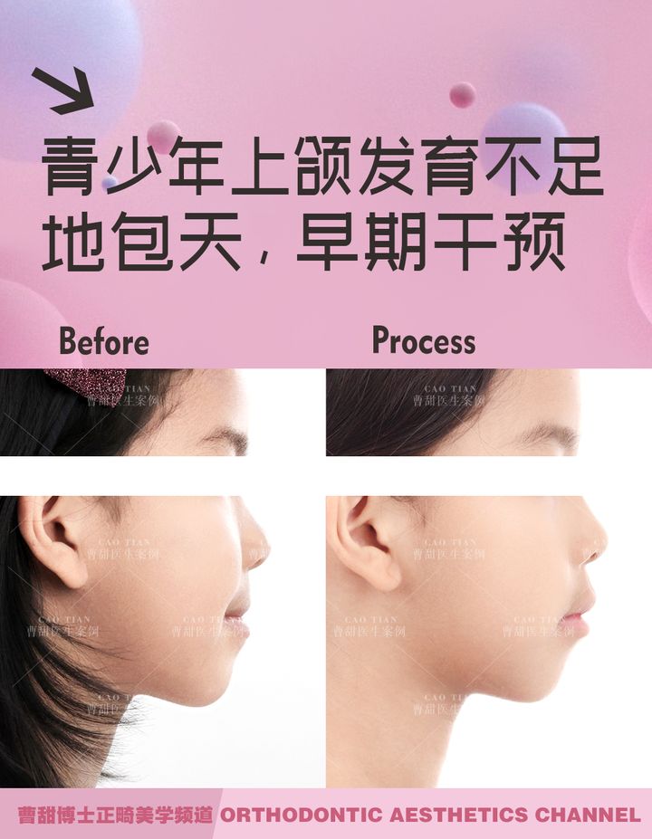 儿童反颌矫正完嘴凸,儿童下颌后缩嘴凸矫正需要多久