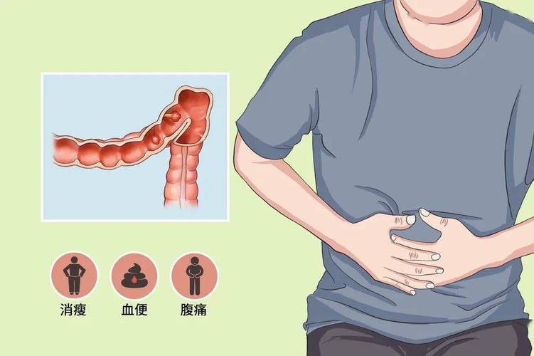 结直肠癌遗传几率高吗,结直肠癌有遗传吗