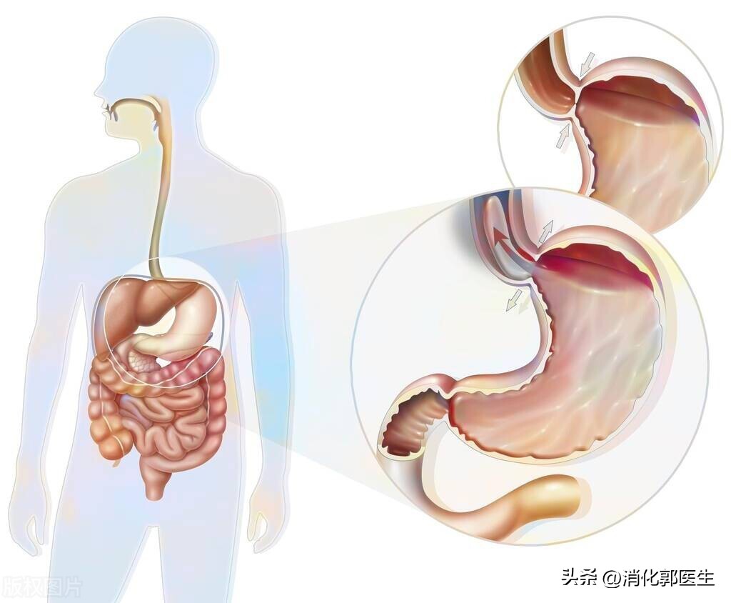 吃东西总是感觉喉咙堵是怎么回事,咽喉炎吃东西有哽噎感食道没问题