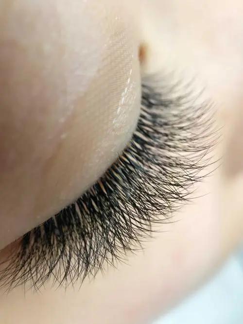 母女俩下腹瘙痒，医生用镊子夹出阴虱！原来阴虱有这4个传播途径