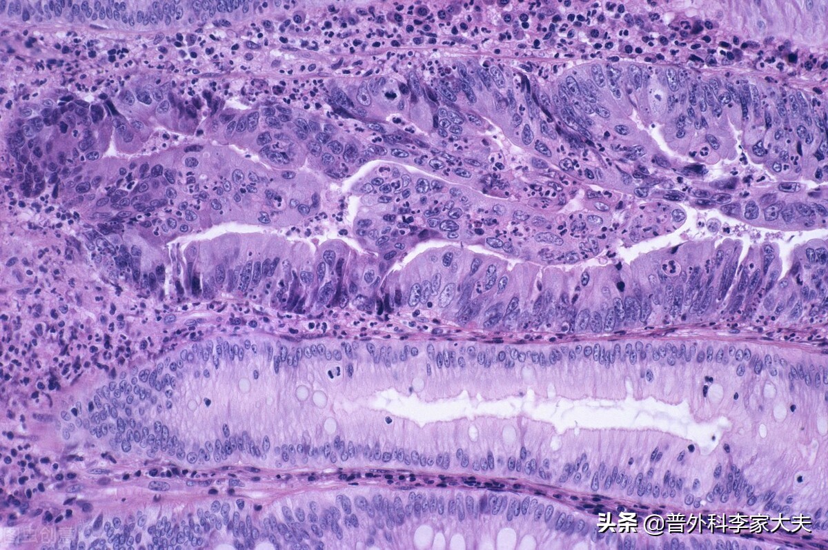 直肠癌的新辅助放疗技术,直肠癌医生建议先化疗再手术