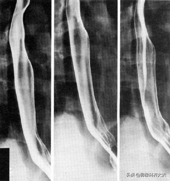 胃肠道造影超声解剖图,胃肠钡餐影像检查片子