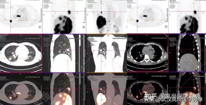 10毫米的肺结节恶性死亡率有多大,1厘米多的肺结节良性可能性多大