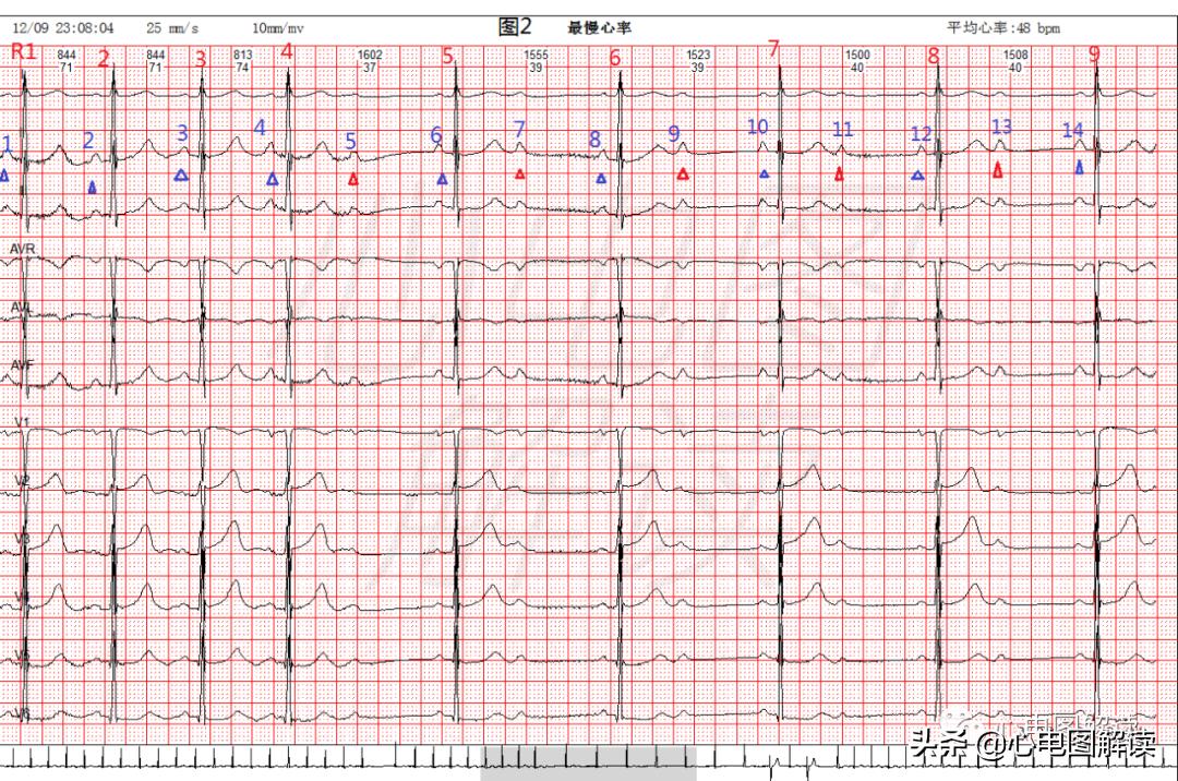 心率最慢42正常吗,最慢心率42正常吗