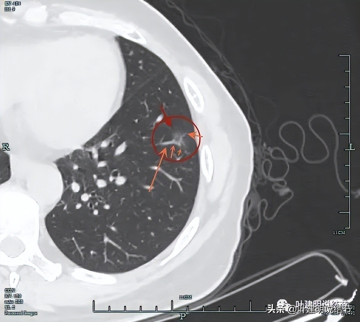 辽宁省肺结节手术哪家医院好,辽宁肺结节手术医院
