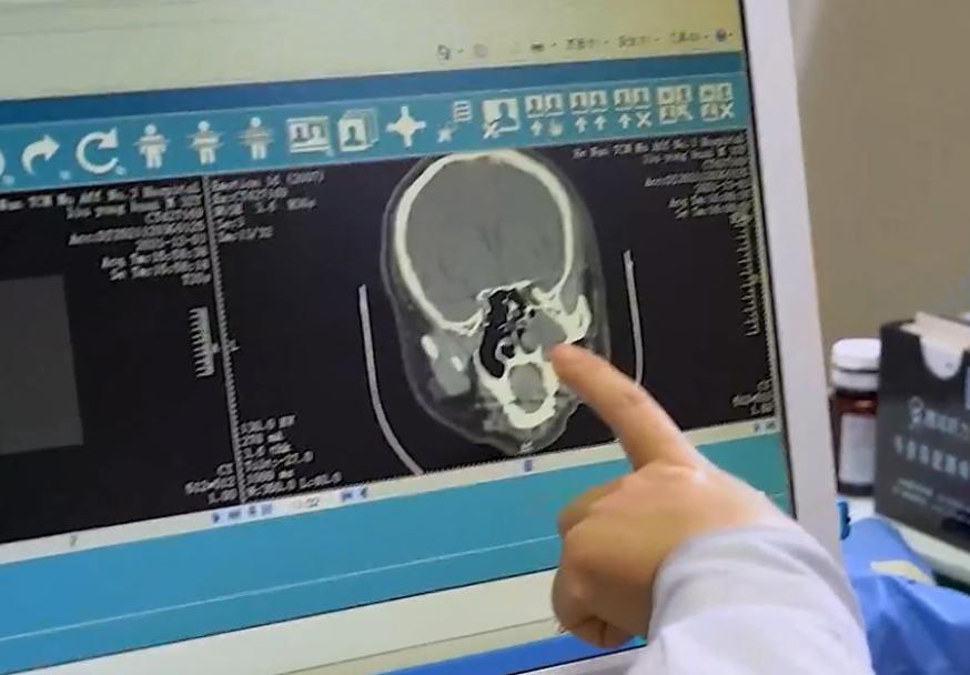 孩子鼻炎腺样体肥大中医怎样调理,常见五种鼻炎的治疗
