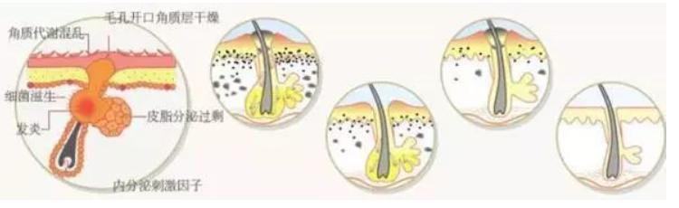 用了护肤品长痘是什么原因,有些护肤品用了会长痘什么原因