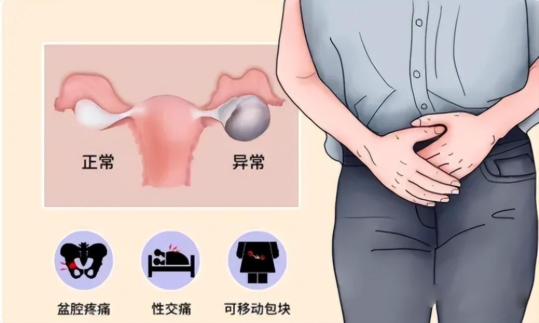 啥是巧克力囊肿,什么是巧克力囊肿动画