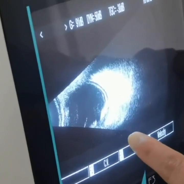 眼底超声检查视网膜裂孔,眼科b超能看出视网膜脱落吗