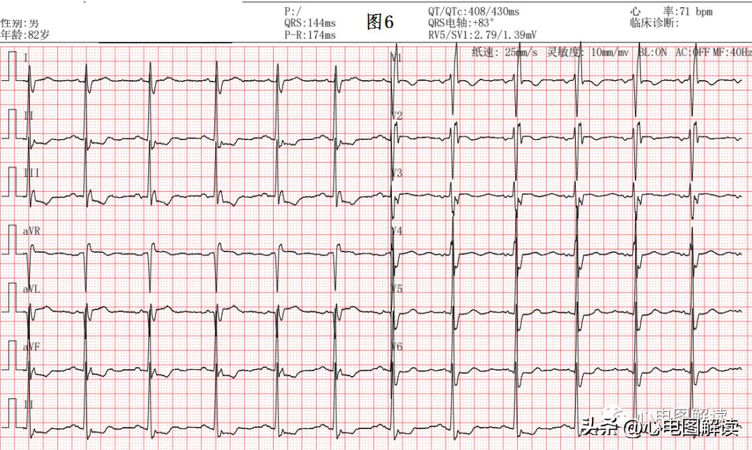 完全性右束支阻滞有什么症状吗,完全性右束支传导阻滞的中成药