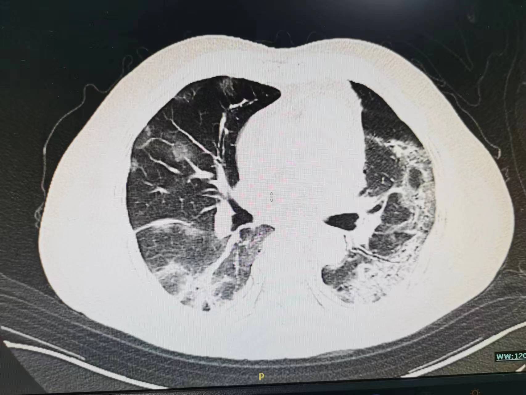 老年人发低热不退是什么原因,老年人阳了一直咳嗽怎么办