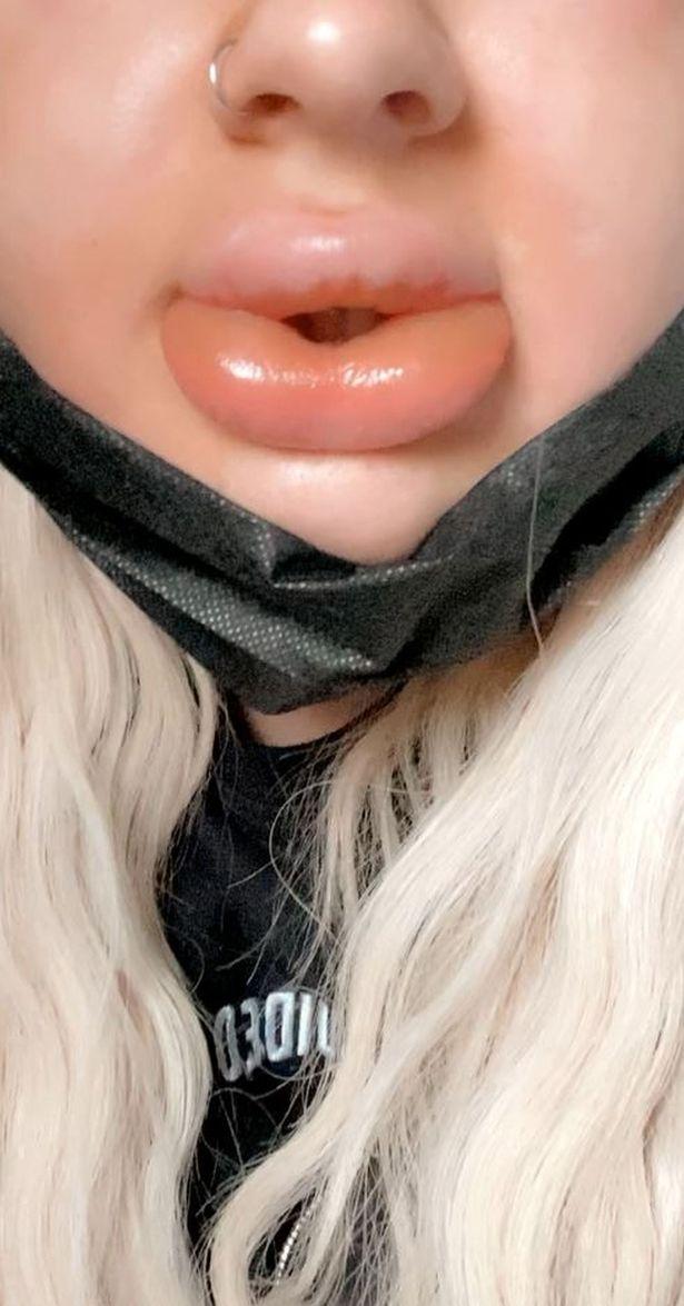 丰唇失败变成香肠嘴,丰唇手术后变成香肠嘴