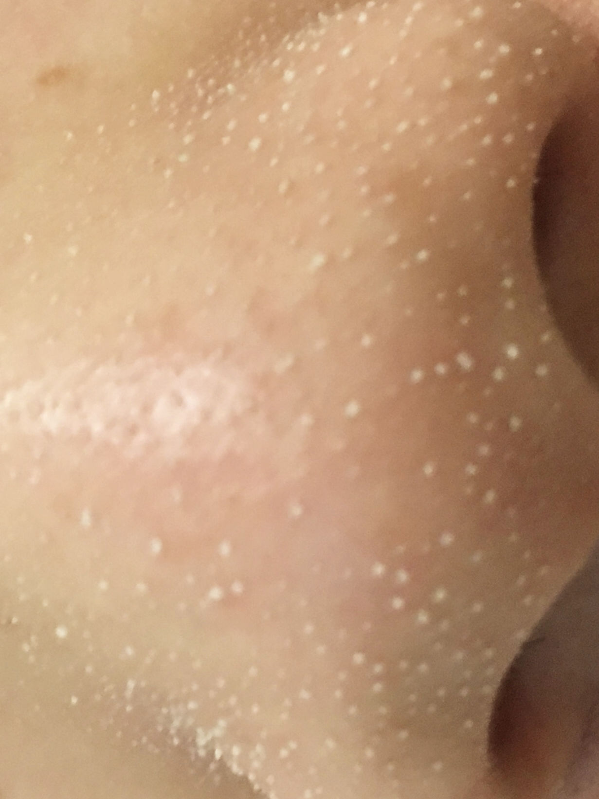 毛孔堵塞毛孔发黑怎样清理,毛孔长螨虫堵塞毛孔怎么办