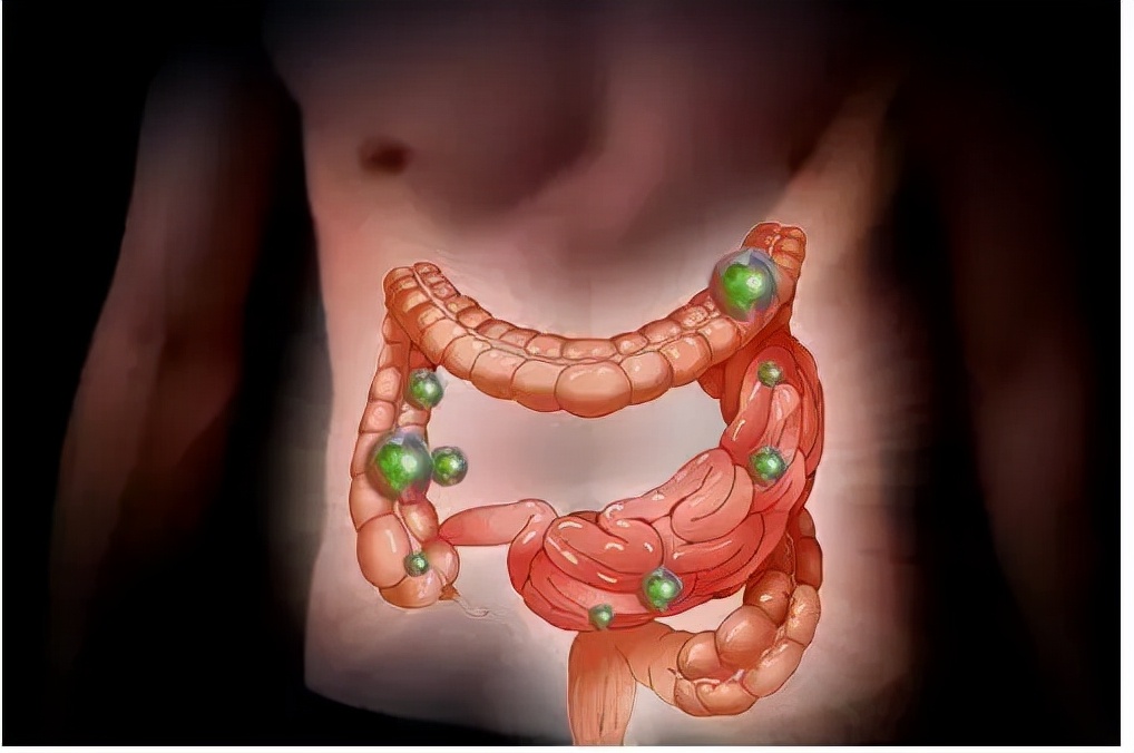 日本便秘小粉丸的功效和副作用,长期吃超量小粉丸会肠癌吗