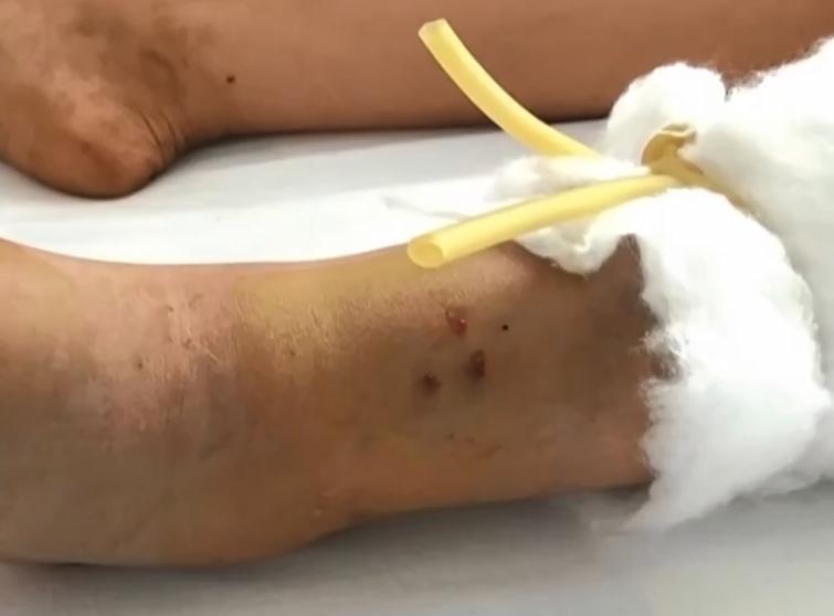 渭南21岁女孩被银环蛇咬死,陕西银环蛇咬伤21岁女子