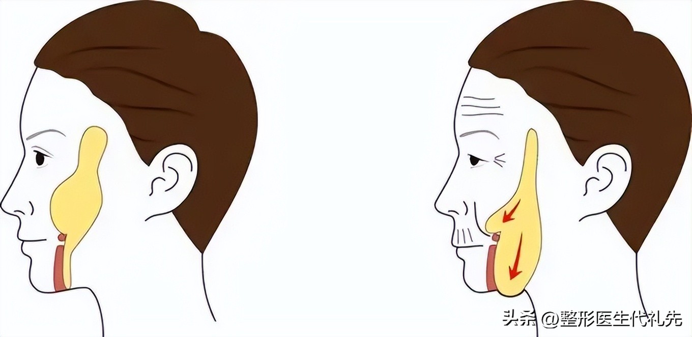 口角囊袋修复效果,口角囊袋成功修复案例