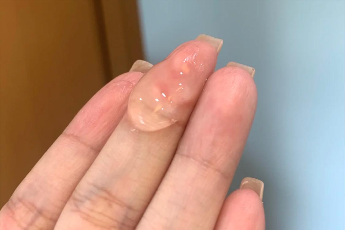 甲硝唑凝胶怎么用最好,甲硝唑凝胶用多久有效