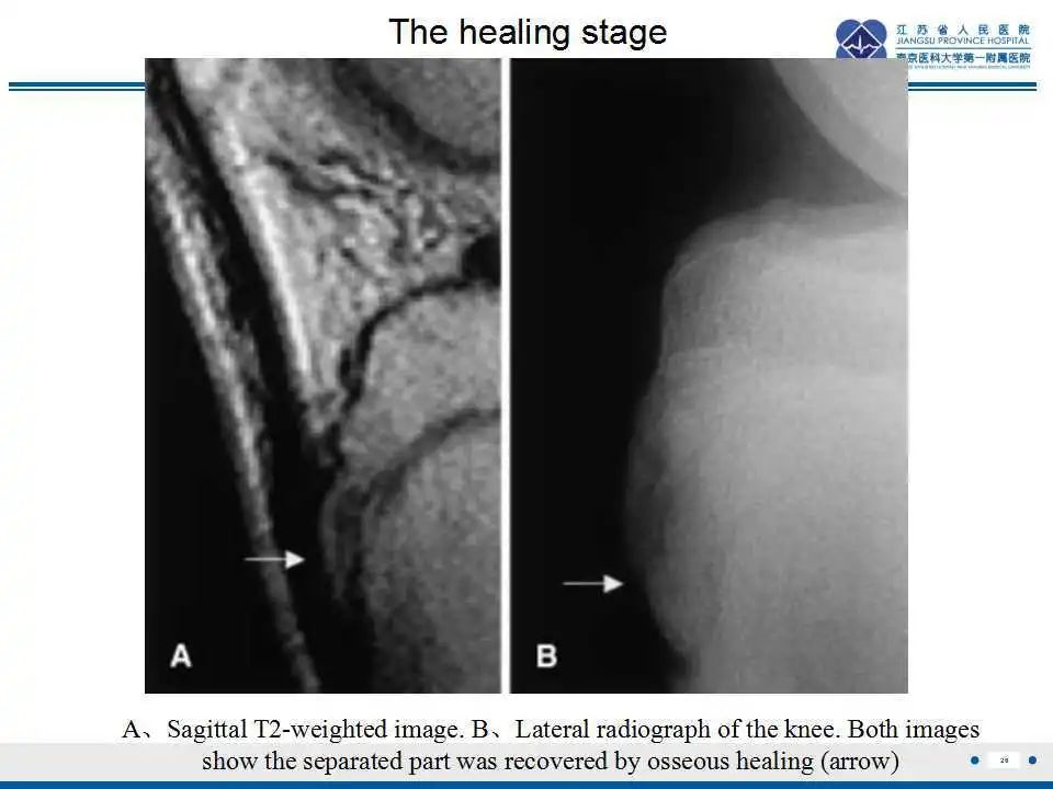 胫骨结节软骨炎要怎么治疗,胫骨结节骨软骨炎会癌变吗