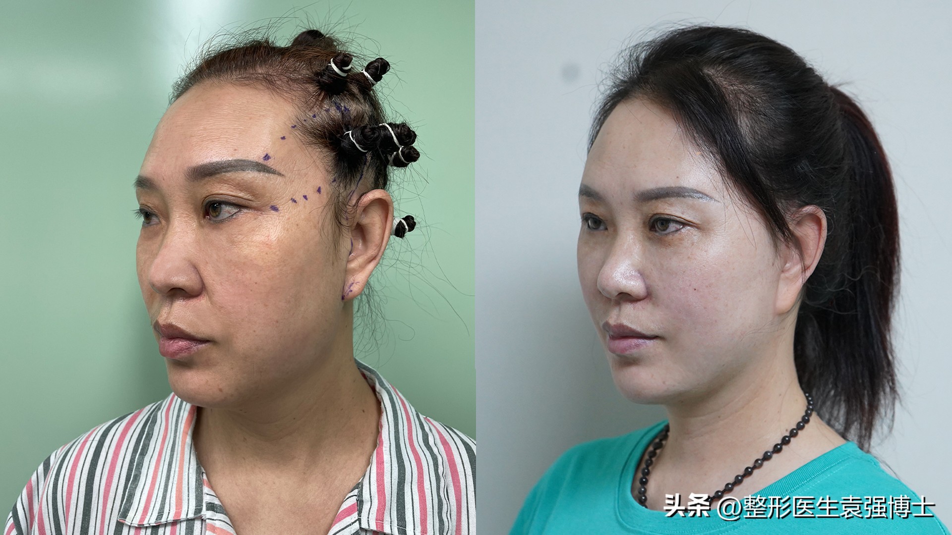 40岁做拉皮多久恢复,47岁拉皮恢复的真实分享