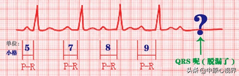 护考几种常见的心电图,常见的心电图图形分析