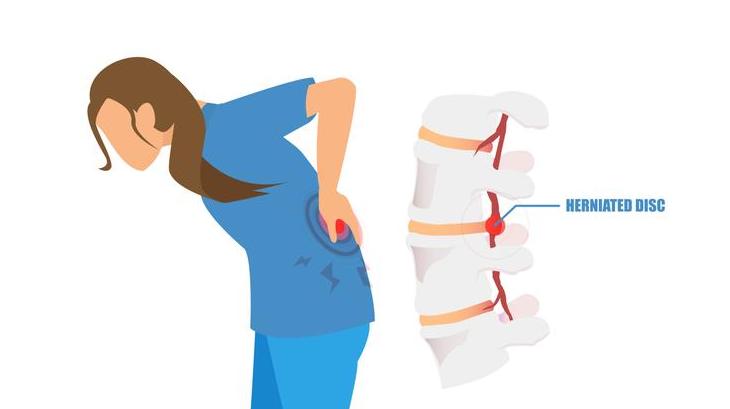 经常开车容易腰椎间盘突出,经常开车导致腰疼怎么缓解