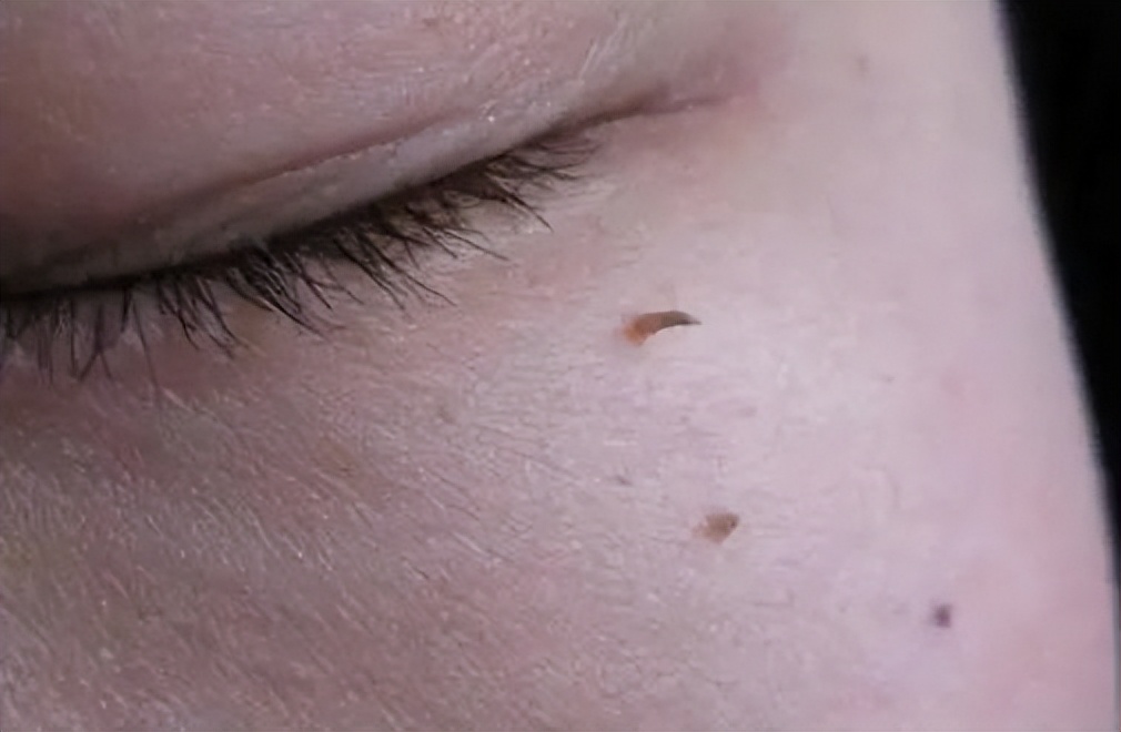 如何根治脖子的小肉球,脖子上的小肉球怎么处理掉