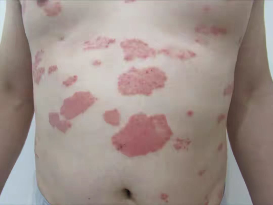 身上有牛皮癣为啥还一直出小红点,全身长满红疙瘩牛皮癣