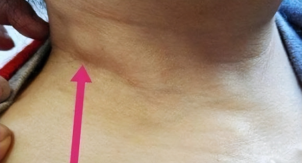 脖子腋下长小肉粒什么原因引起的,脖子上和腋下长小肉粒是什么原因